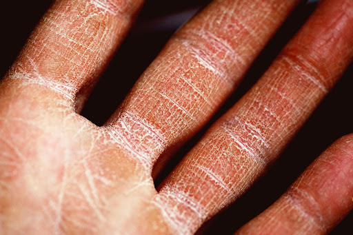 Mężczyzna z atopowym zapaleniem skóry na dłoniach